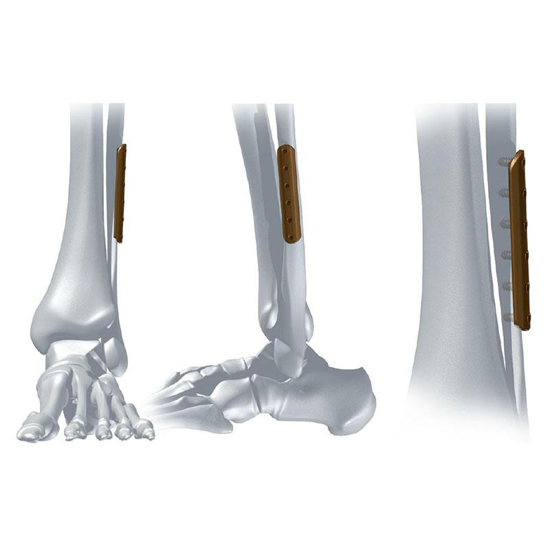 Пластина 1/3 трубчата пряма 5,0ChLP